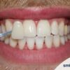 Qu'est-ce que le blanchiment dentaire américain ?