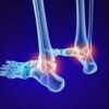 Pourquoi les semelles orthopédiques sont mal remboursées ?
