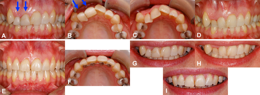 Pourquoi l'orthodontie coûte si cher ?