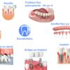 Comment tient un dentier du haut ?